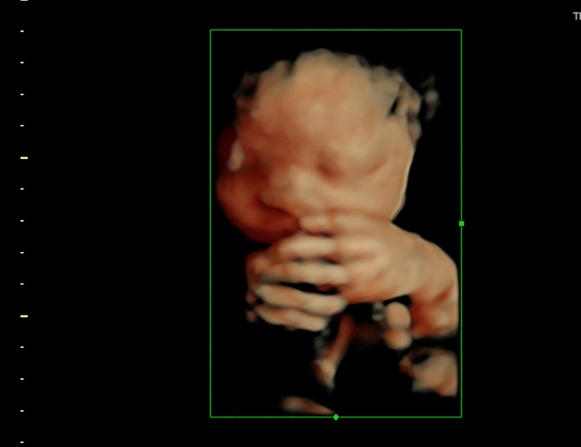 3D ultrasound image at 29 weeks